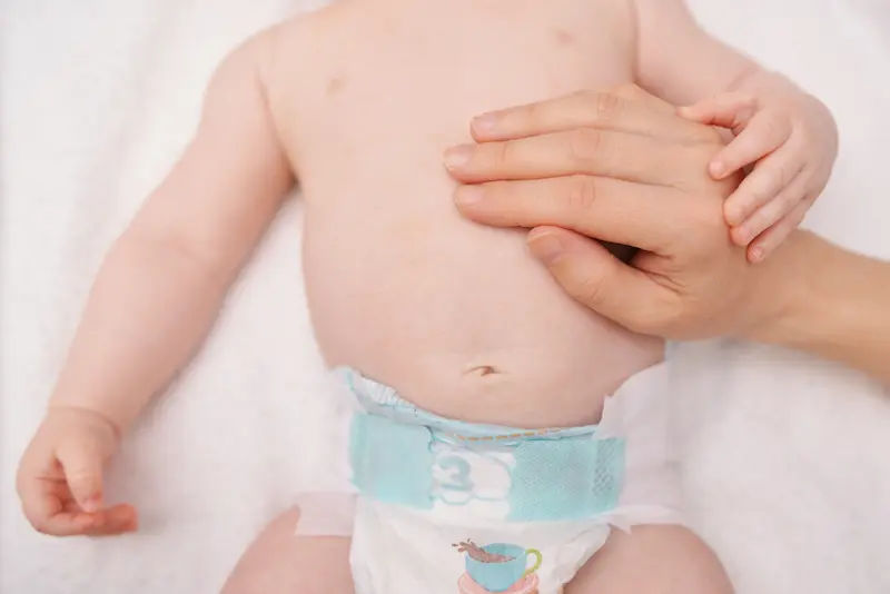 Omphalocele: Overview of Causes and Treatment